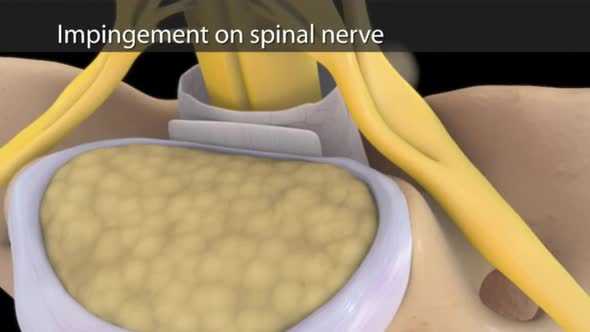 Impact on the spinal nerve