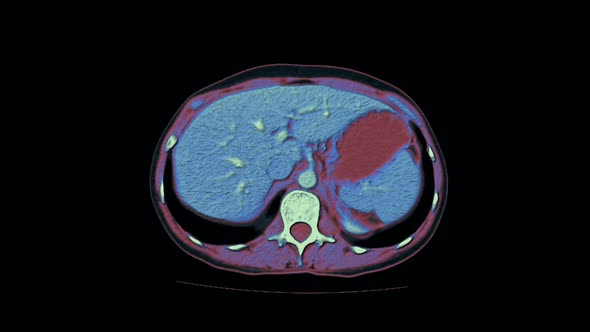 Contrast MRI of the Abdominal Cavity, Gastrointestinal Tract, Bladder