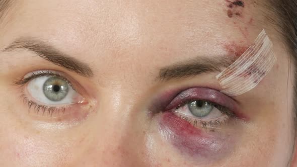 Large Real Bruise Hematoma Under the Eye of a Young Woman Fresh Purple Bruise and Scratches on the