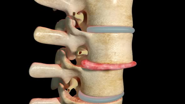 Spondylolisthesis   Vertebra Displacement