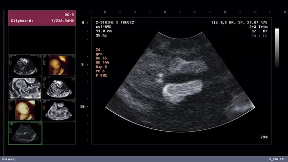 Diagnostic ultrasound screening of body during pregnancy determines sex of baby