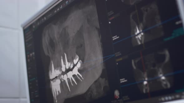 Dentist Doctor Examines a Panoramic Xray of the Jaw on a Computer Screen
