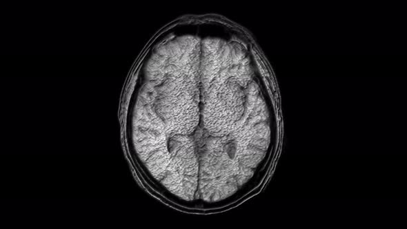 Voluminous MRI Scans of the Brain and Head To Detect Tumors. Diagnostic Medical Tool