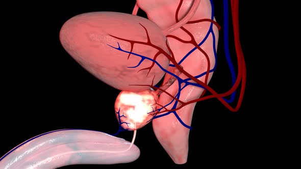 Benign Prostatic Hyperplasia