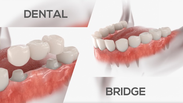 Dental Bridge