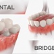 Dental Bridge - VideoHive Item for Sale