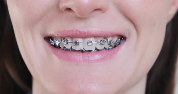 Female Smile with Metal Braces Teeth Closeup