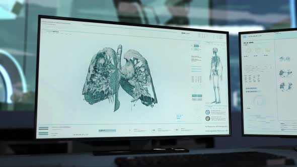 X-ray Analysis Of Patients Lungs Organ In A High Tech Computer Program