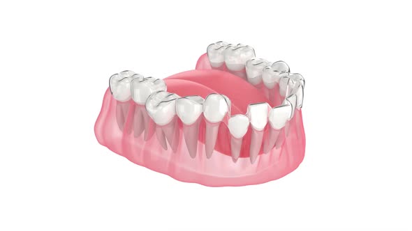 Clear invisalign aligner splint make toothing correction