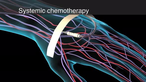 Brachytherapy is a type of radiotherapy, the radioactive source