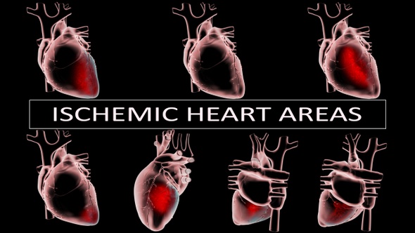 Ischemic Heart Areas