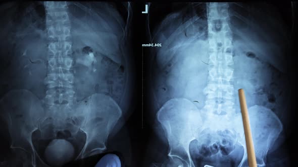 Kidney With A Stone. Oxalate Stone On X Ray