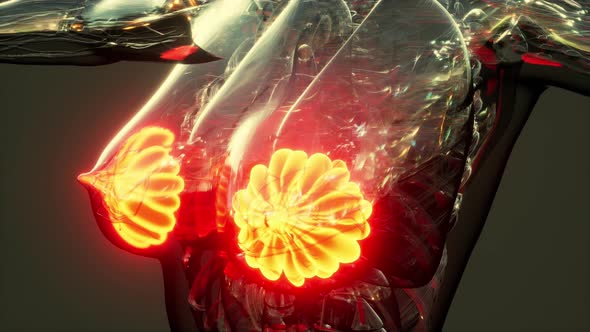 Female Breast with Cancer Focus of Inflammation alt