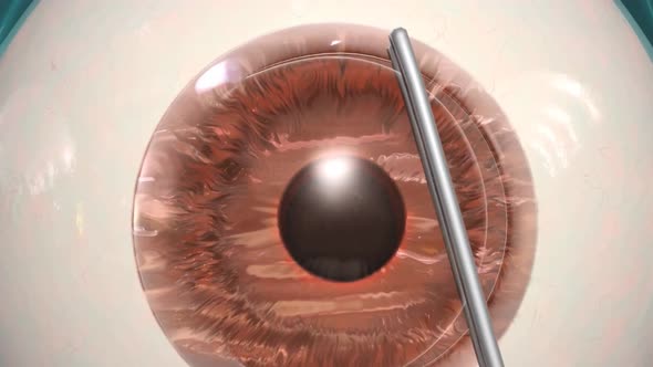 Surgical operations on the human eye