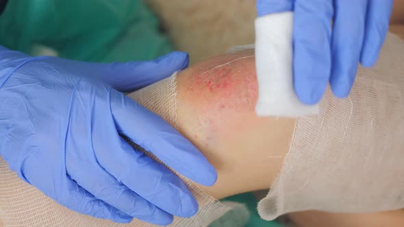 The Doctor's Hands in Blue Sterile Gloves Pours Antiseptic on a Cotton Swab to Treat the Patient's