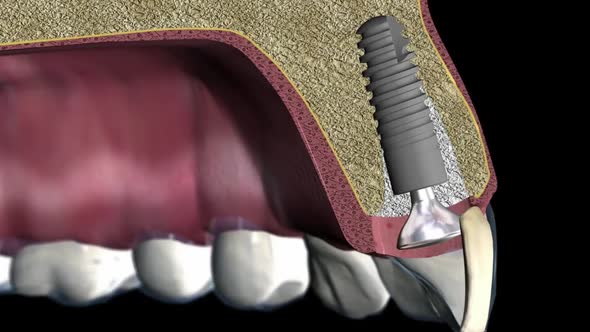Placement and alignment of the implant