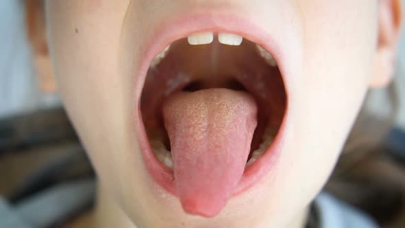 Wide Open Mouth with a Tongue Stuck Out View of the Uvula and the Soft Palate of Little Girl