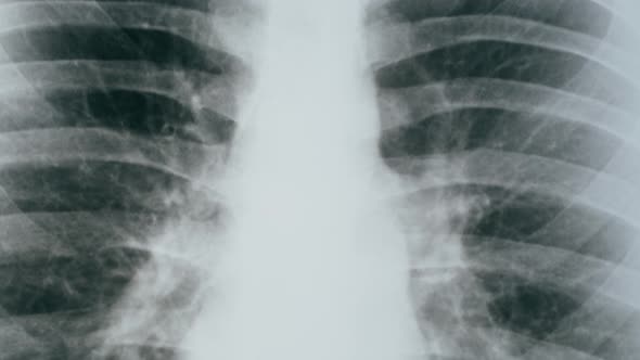 Lungs Xray Closeup