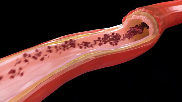 Atherosclerosis - Plaque build up from cholesterol