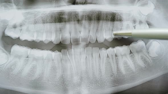 Close Up View of Dentist Examines a Panoramic Xray of the Teeth Shows the Problem Teeth on the Xray