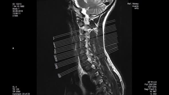 MRI Scans, Lumbar Spine, Showing the Sizes