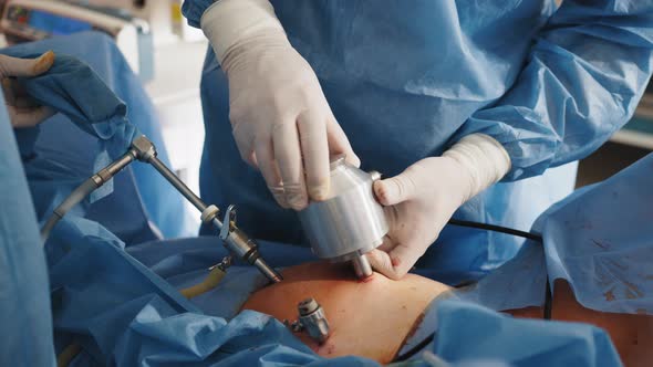 Process of Surgery Operation Using Laparoscopic Equipment