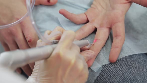 Removal of Warts Laser on the Fingers