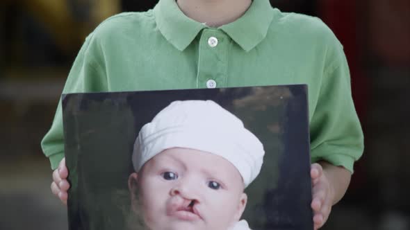 Slow motion of boy smiling with cleft lip.