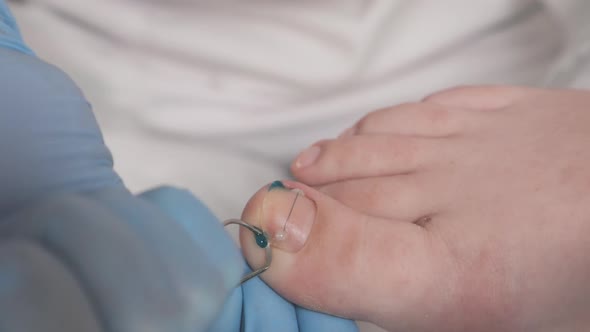 Podiatrist installs a titanium thread at big toenail and using medicine. Closeup