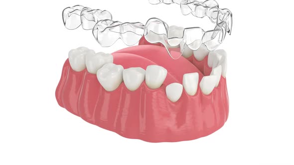 Clear aligner splint make bite correction