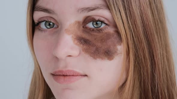 Young Woman with Rash Under Eye