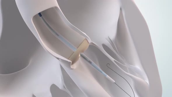 The Cardiovascular System. 3D Medical animation of the Aortic Valve Expansion