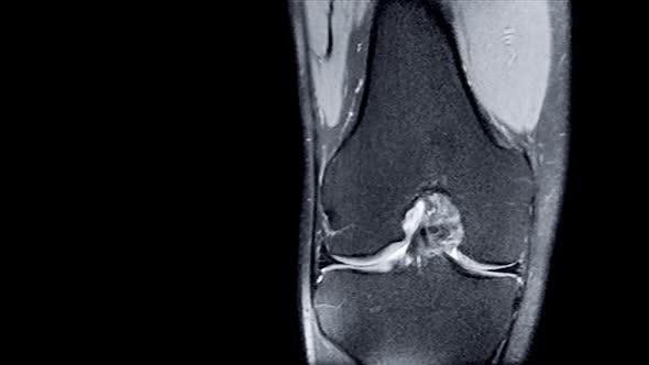 Magnetic Resonance Imaging (MRI) of Right Knee