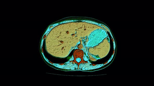 Color Contrast MRI of the Abdominal Cavity, Gastrointestinal Tract, Bladder