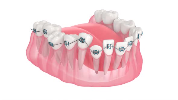 Teeth alignment by orthodontic braces isolated over white background