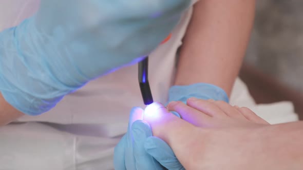 Professional chiropodist installs a titanium thread on the big toe and using UV gadget