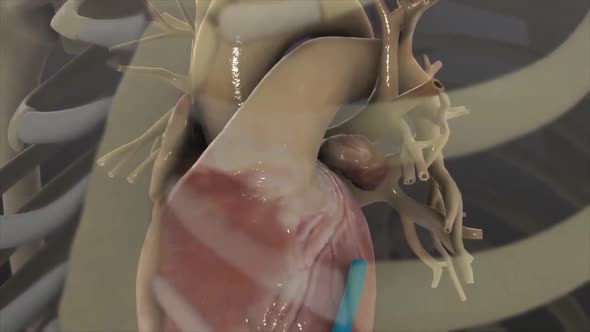 Stent Angioplasty Procedure 3d medical