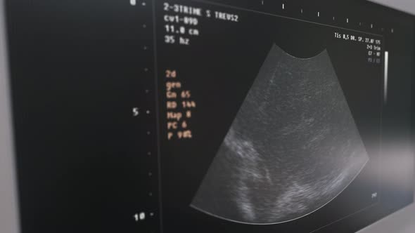 Prenatal Baby diagnostic analysis identifies the male genitalia of the child alt