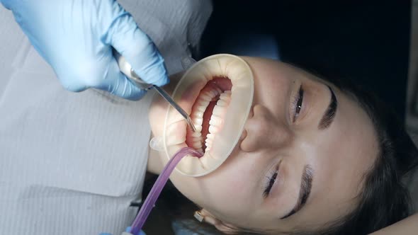 Young Woman with a Retractor in Her Mouth in a Dental Clinic