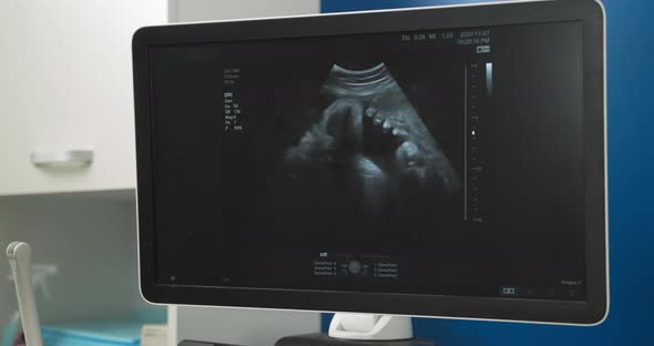 Ultrasonography of Pregnant Woman