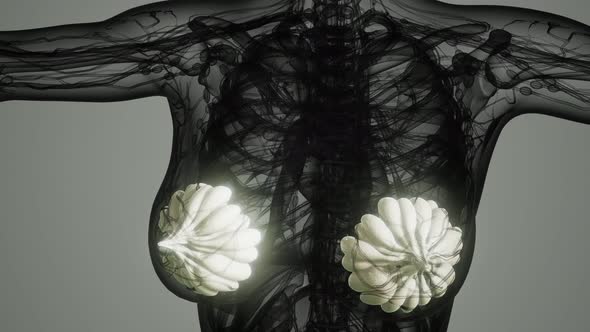 Medical Scan of Woman Breast Cancer