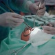 The Doctor Performs a Pediatric Surgical Operation to Remove the Tonsils - VideoHive Item for Sale