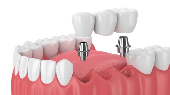 Jaw with implants supporting dental bridge over white background alt