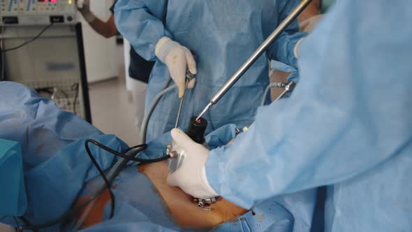 Surgeons Team During Process Operation Uterus Removal with Surgical Laparoscopy