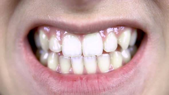 Young Woman Shows Crooked Teeth. Close-up