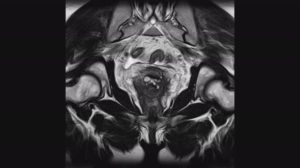 MRI of the Female Pelvic Organs, Abdominal Cavity, Gastrointestinal Tract and Bladder