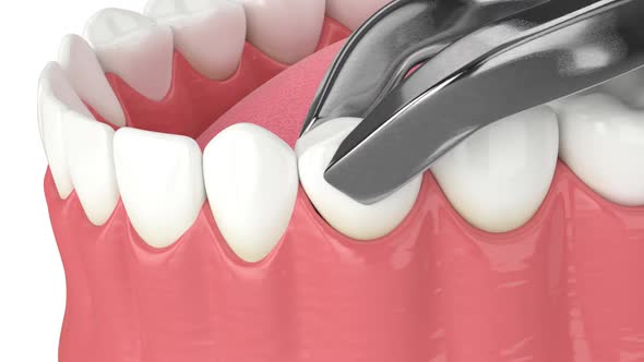 Jaw bone recession after tooth extraction