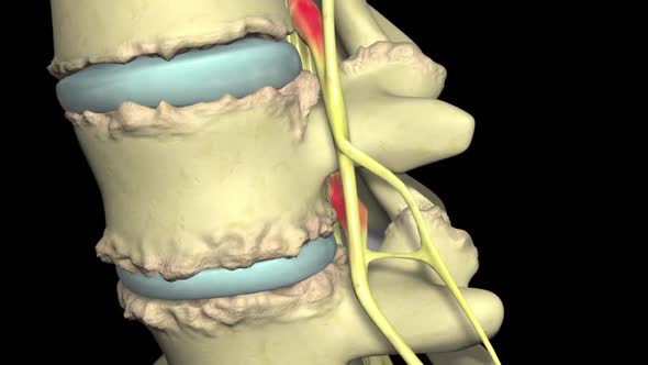 Spinal stenosis is the narrowing of the bony canals through which the nerves and spinal cord pass.