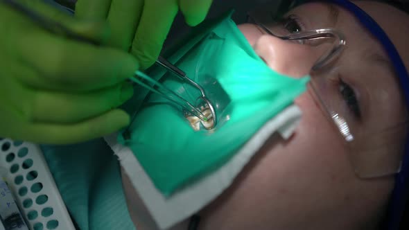 Closeup Face of Young Woman with Dentist Hands Cleaning Tooth Hole Reflecting in Dental Mirror