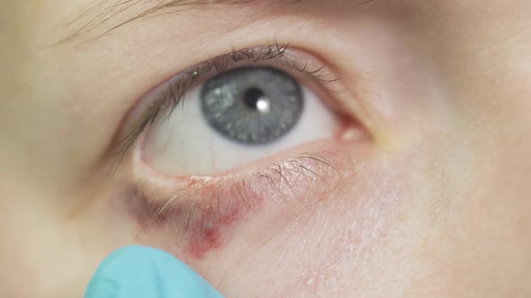 An Ophthalmologist Examines the Eye of a Patient with Blepharitis